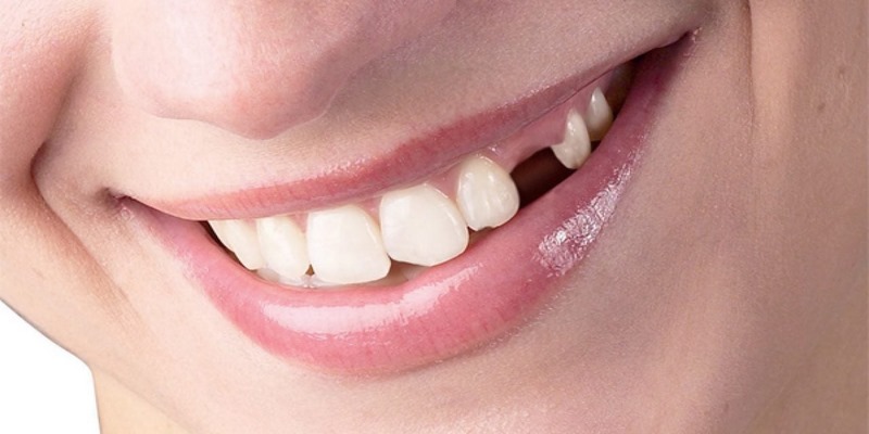Lý do mơ thấy răng rụng